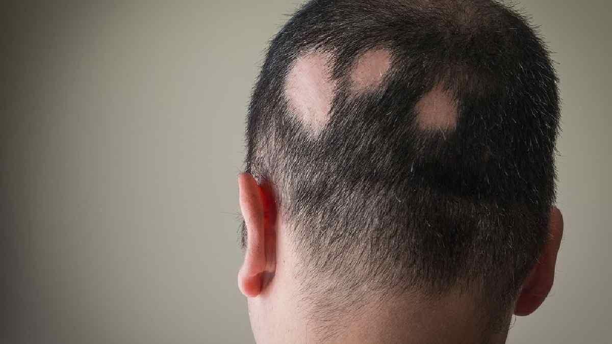 Iron biotin and zinc among top nutrients those deficiency cause hair fall