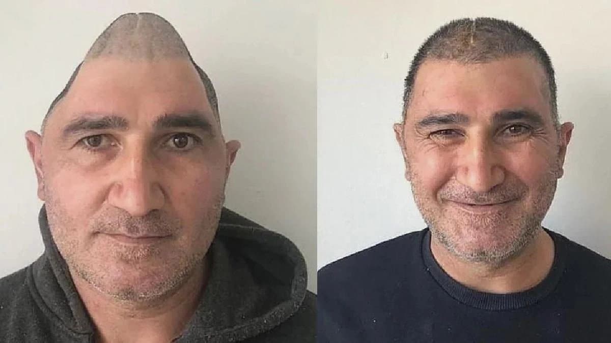 Istanbul doctors 3d prints patient skull to save his life in a Miraculous Incident