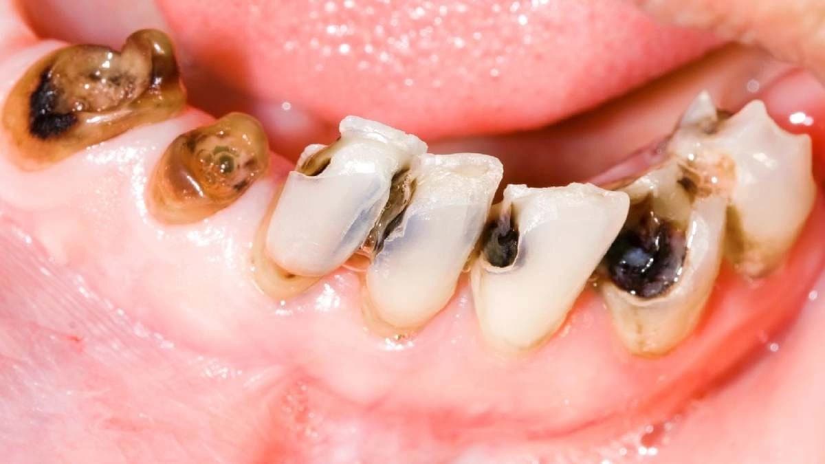 Foods other than chocolate and sweet which can cause dental cavity