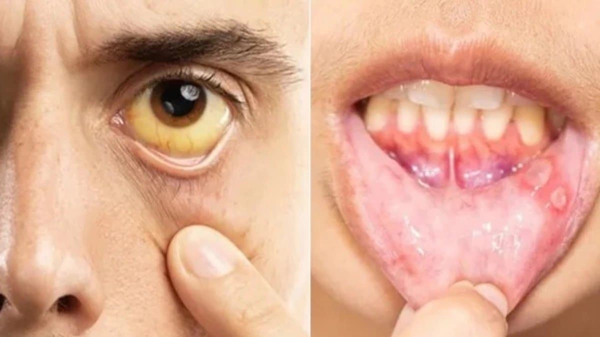 Health Tips: These are symptoms of Vitamin B12 deficiency