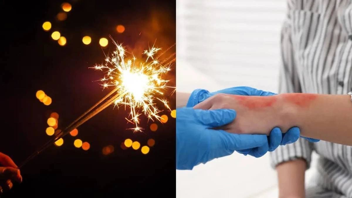 Diwali 2025: How to treat burn injuries during bursting cracker in Kali Puja 
