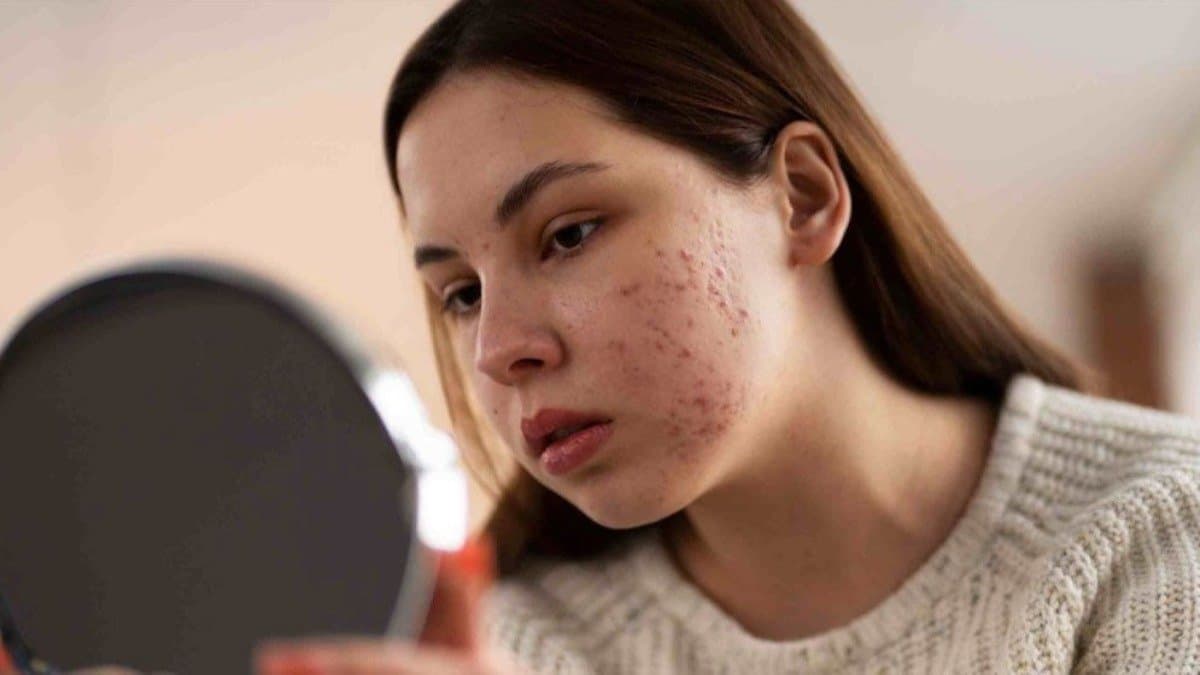 these homemade face packs help to remove acne spot of face quickly know how to make it lif