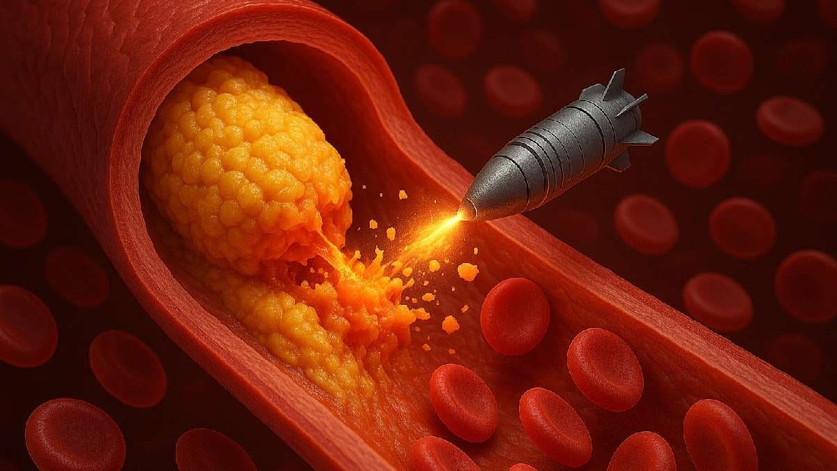 This microscopic medical device can destroy cholesterol pluck