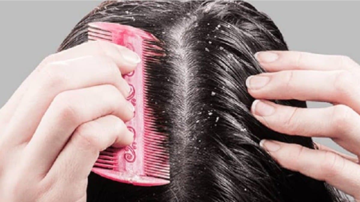 This homemade hair oil helps to reduce dandruff problems 