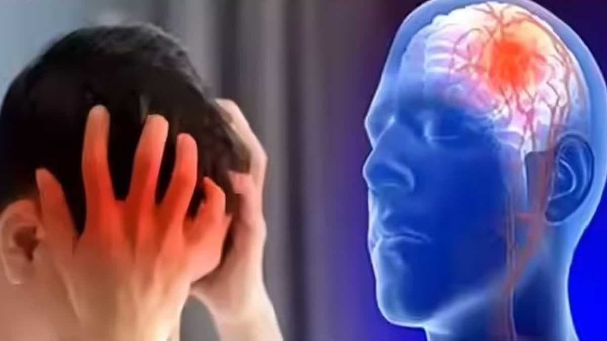 World Stroke Day: Why more young people are getting stroke these three step formula minimise death risk