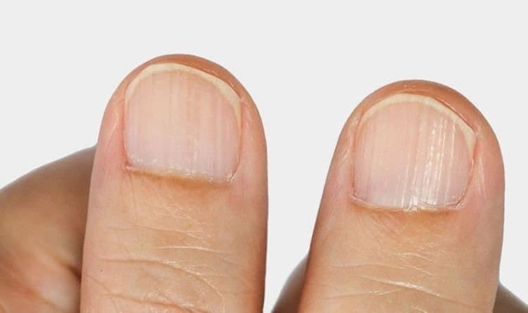 These warning signs of vitamin B12 deficiency on nails 