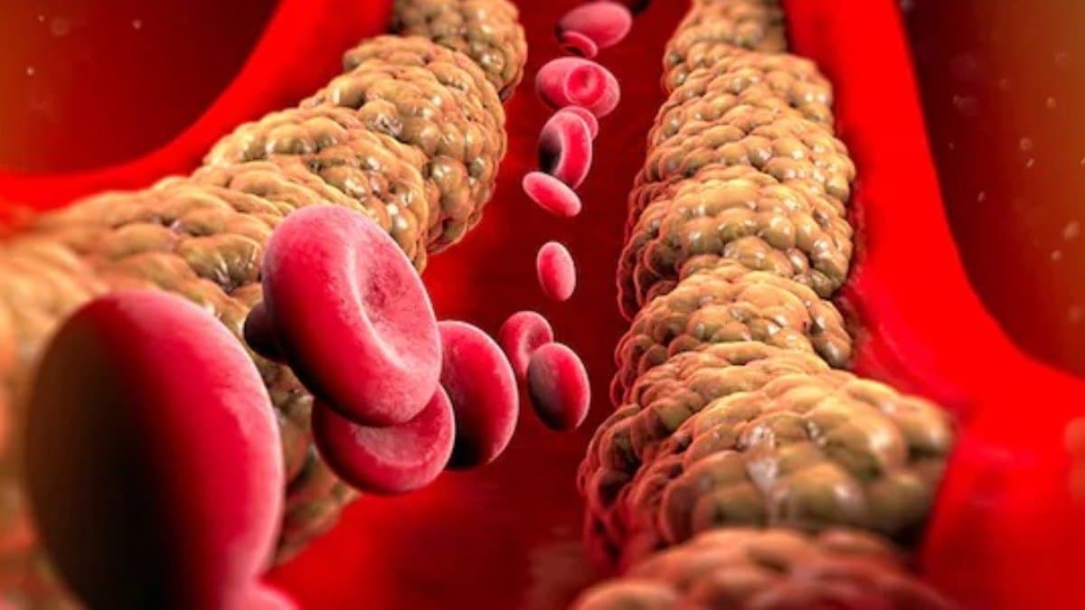 These unusual Factors lead to sudden increase in cholesterol level