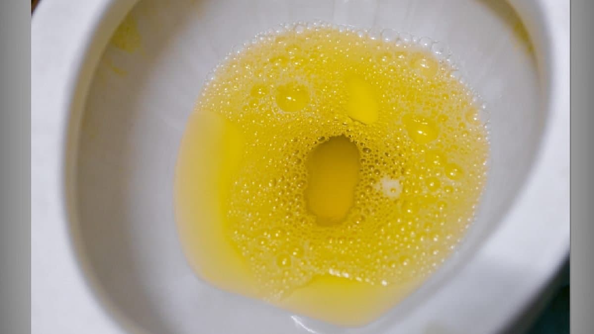 Dehydration among top reasons of Yellow Urine