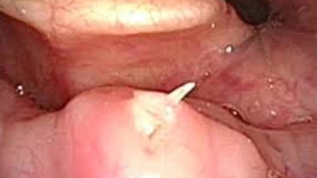 Lemon can help plucking away fish bone inside throat