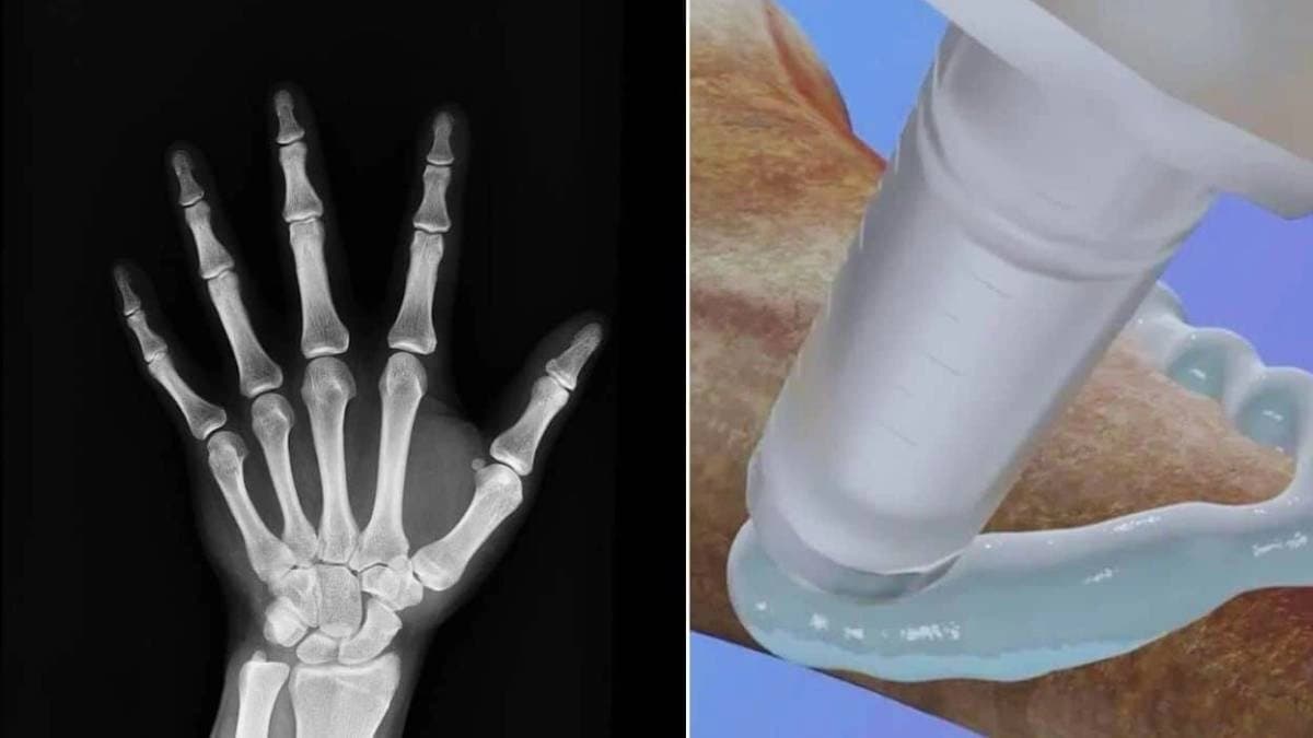 Chinese scientists create bone glue that heals fractures in just three minutes