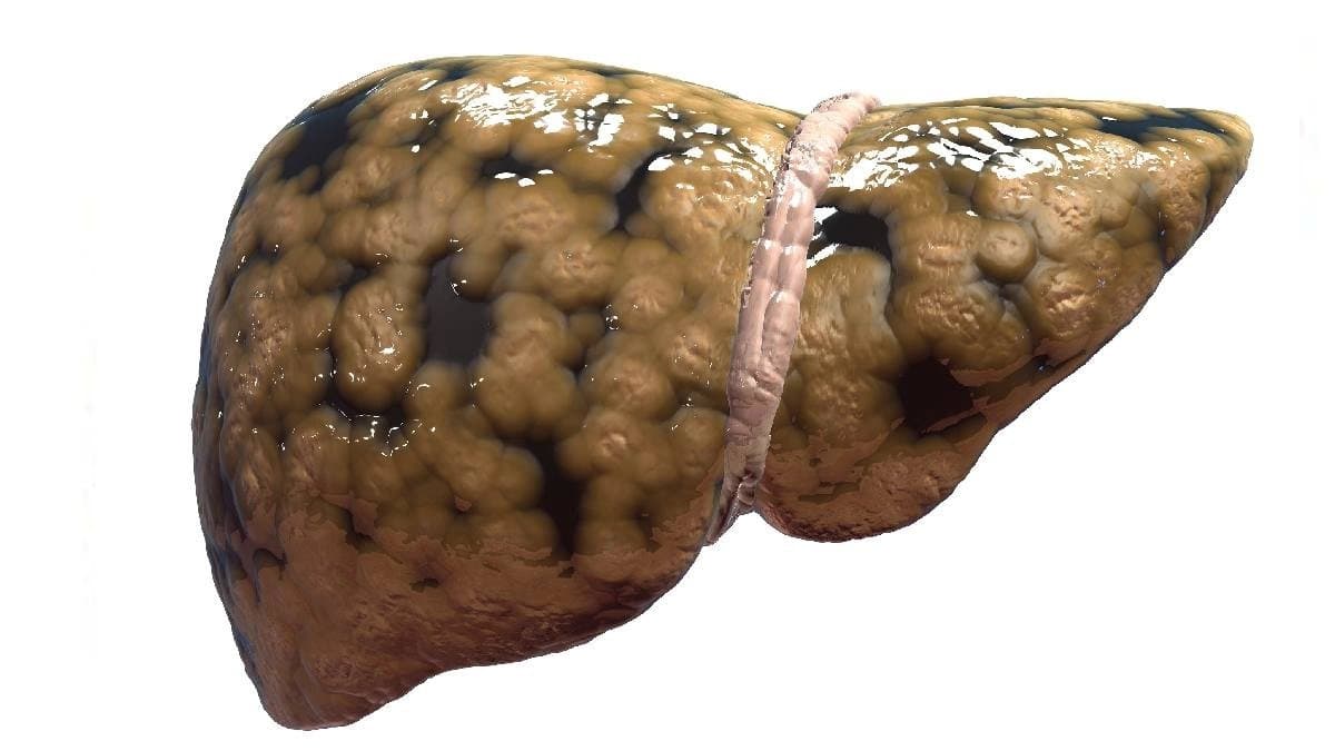 Use these five techniques to reduce Fatty Liver and make it healthy