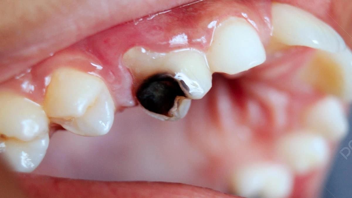 New dental vaccine could resist Dental cavity for entire life says scientists