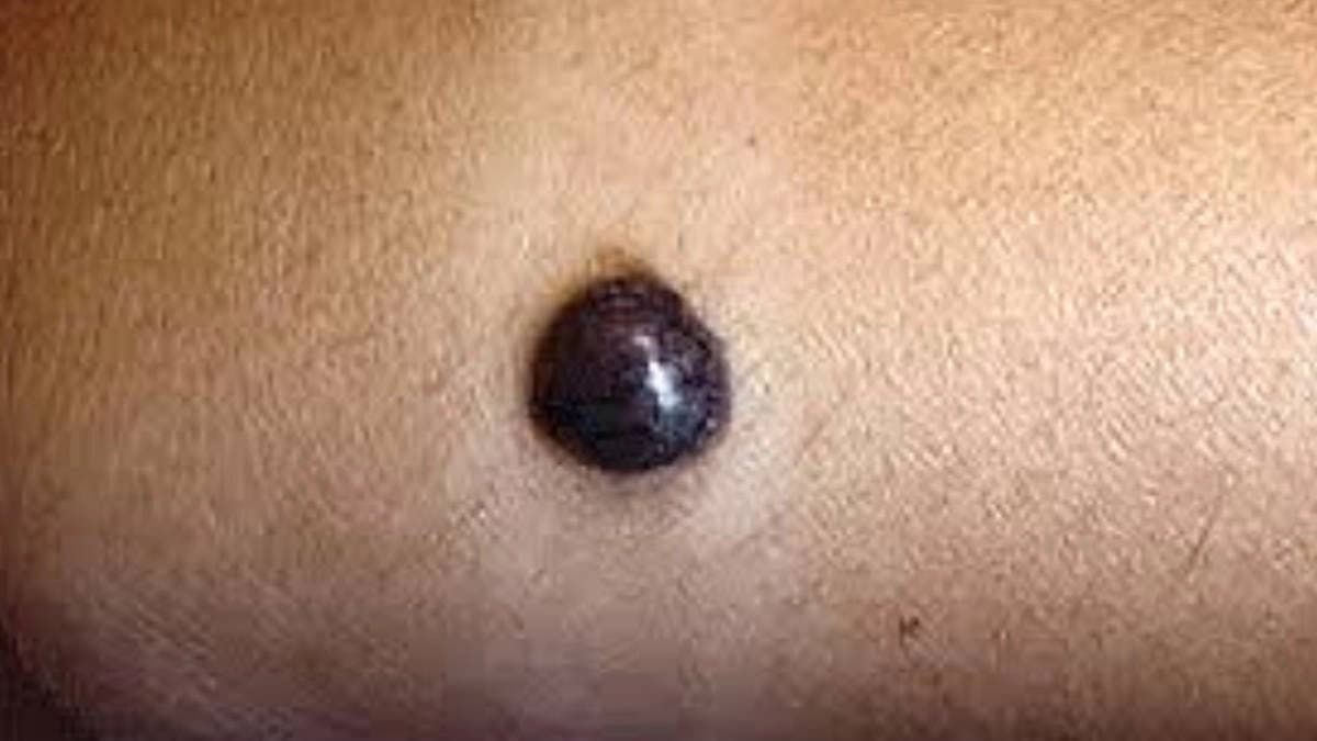 Moles on private part have inner meanings