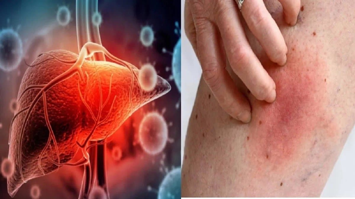 Fatty Liver Symptoms: These skin changes indicate you have liver disease