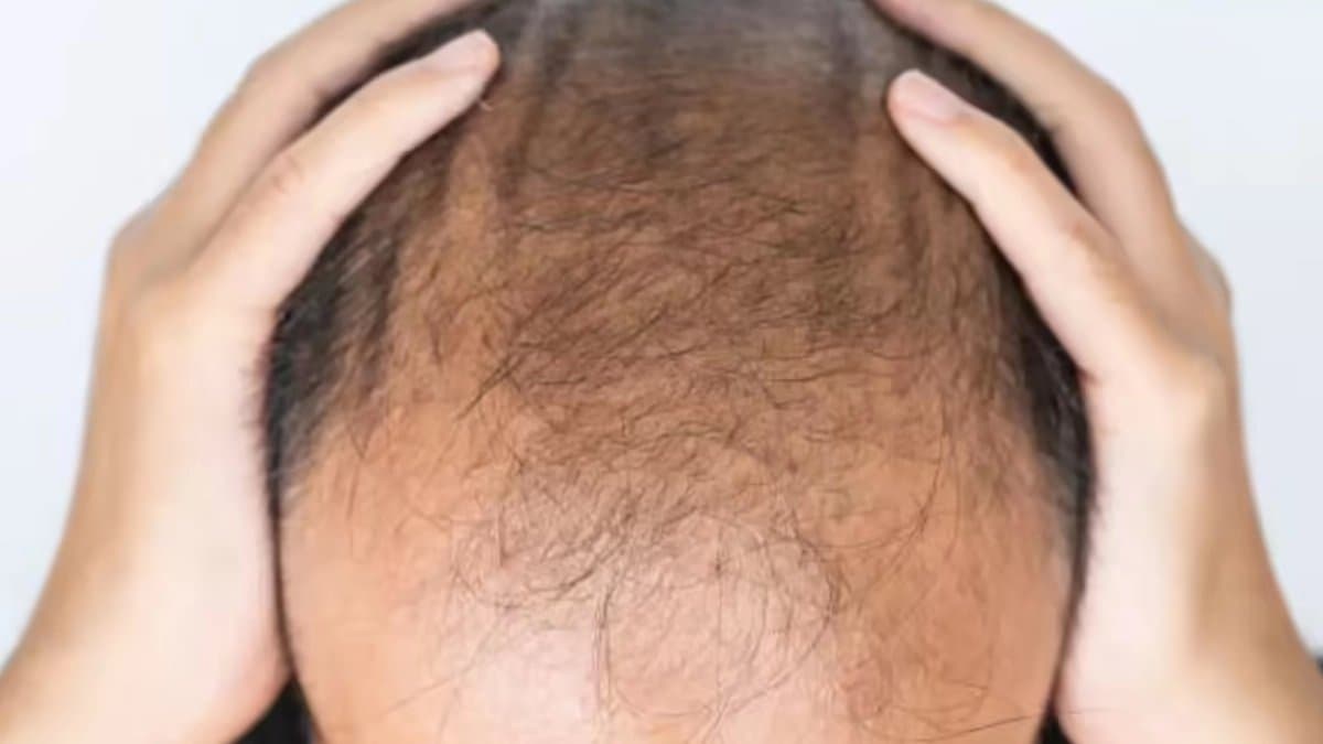 মাথা ভর্তি টাক, এই জিনিস লাগালে মাত্র ২০ দিনেই চুল গজাবে ফাঁকা জায়গায়! বিজ্ঞানীদের অবাক করা দাবিতে হইচই 