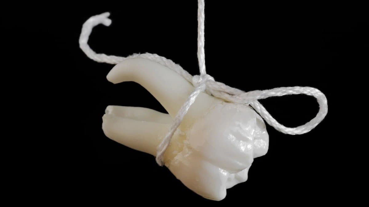 Stem cells extracted from Wisdom teeth can potentially Cure Nerve Disease and Heart Failure