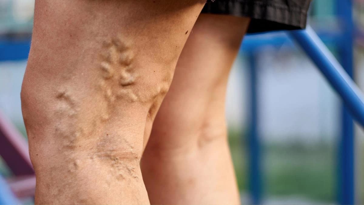 what is Varicose veins and what are the symptoms and causes