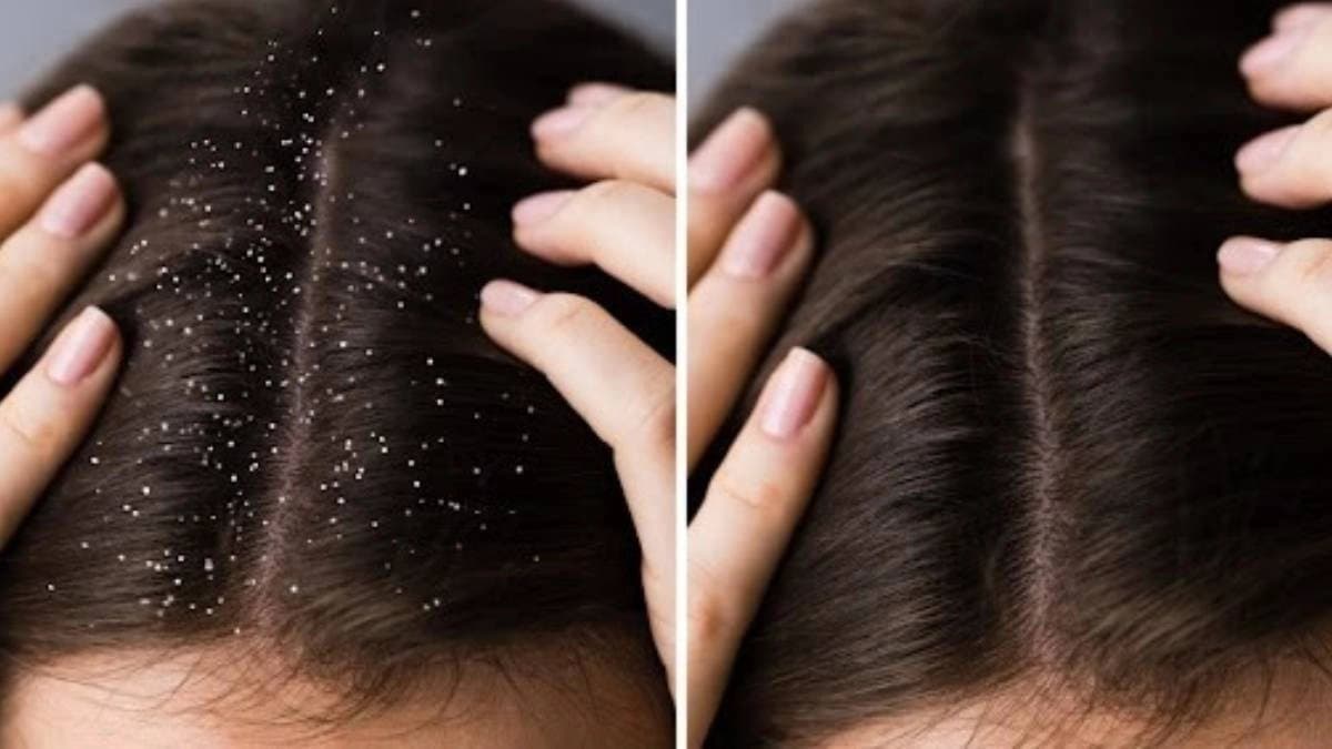 These home remedies help to prevent dandruff