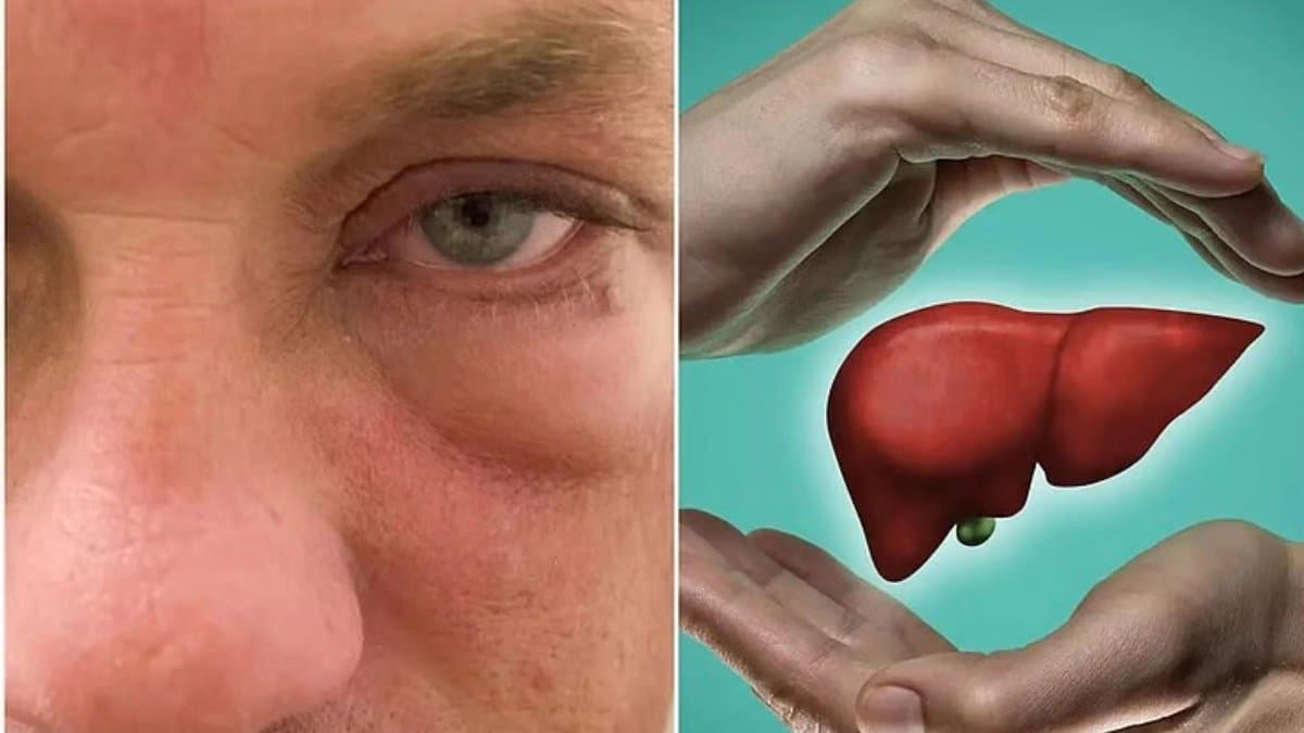 What are the symptoms of liver disease in the face