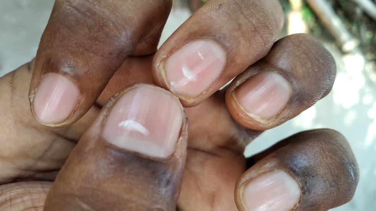 White nail spot symptoms reasons