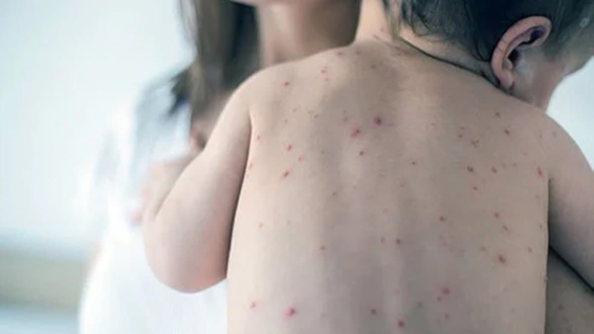 Why Chicken pox is called Mata in several parts of India