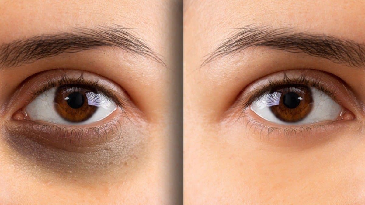 potato mixed with coffee and turmeric works like magic as it removes dark circle within 7 days lif 