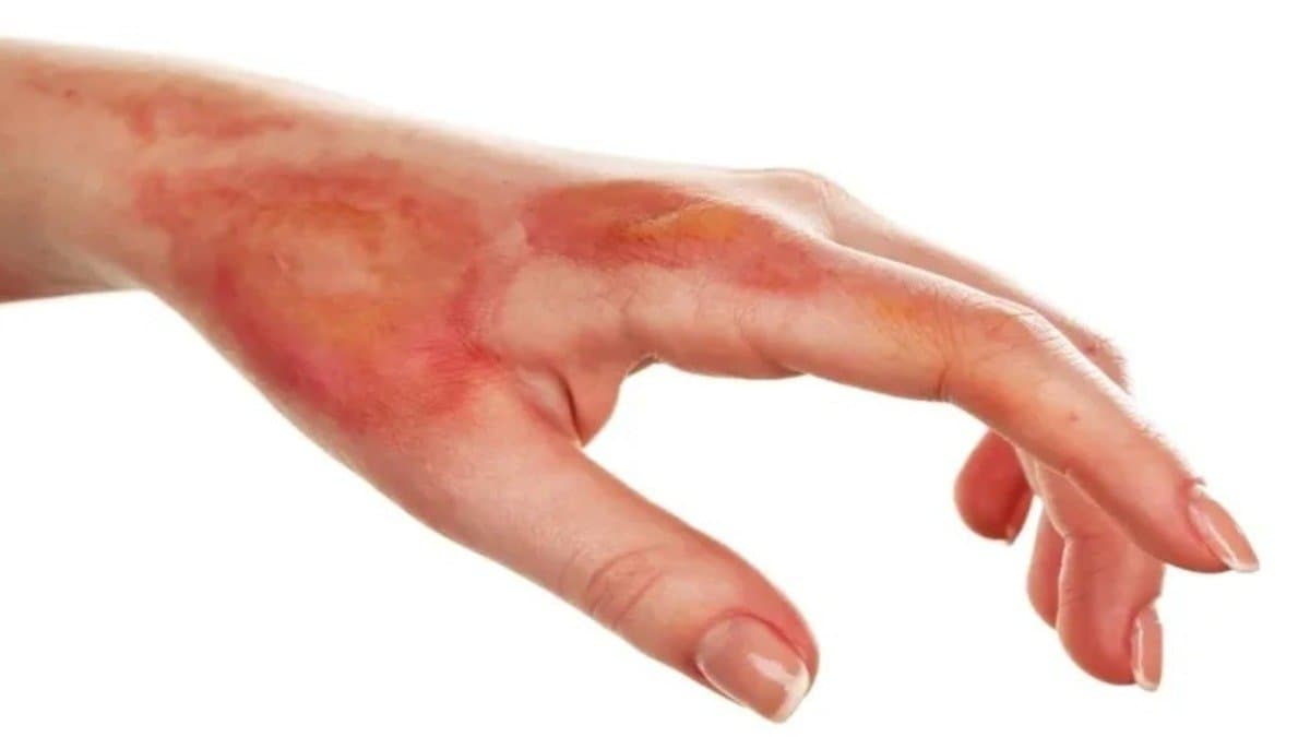 Do you know why experts warn against putting ice on burns 