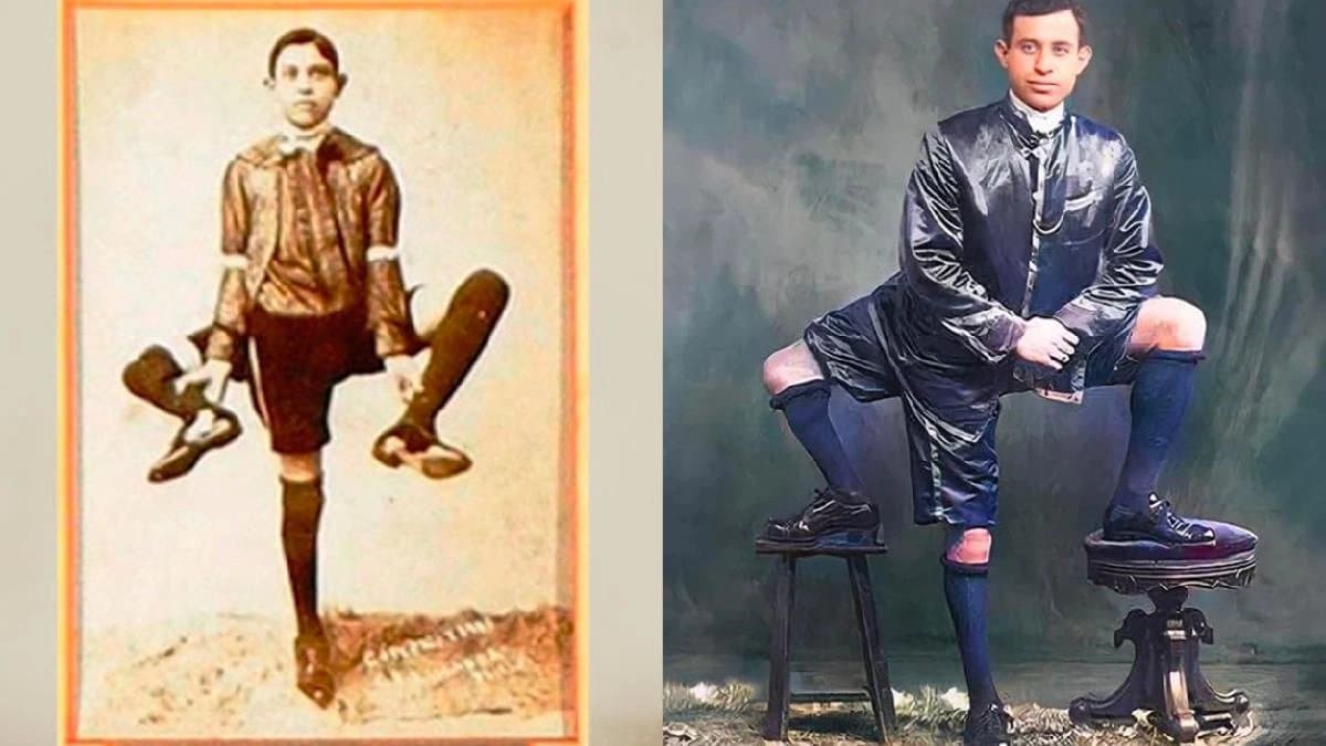 Frank Lentini had three legs a Rare Disease but always stood up for himself