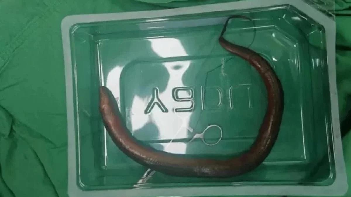 Eel fish has been recovered from a man in China