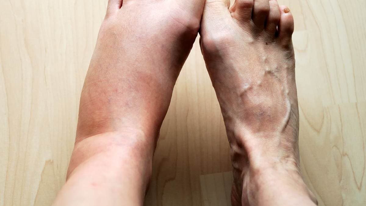 Amla ginger cucumber among top drinks to prevent and reduce Uric Acid