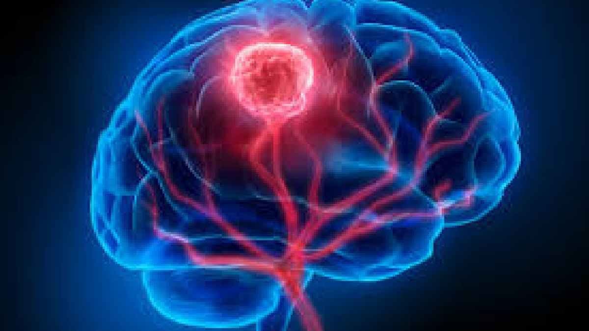 Ten Nurses Diagnosed with Brain Tumors on same Hospital create panic 