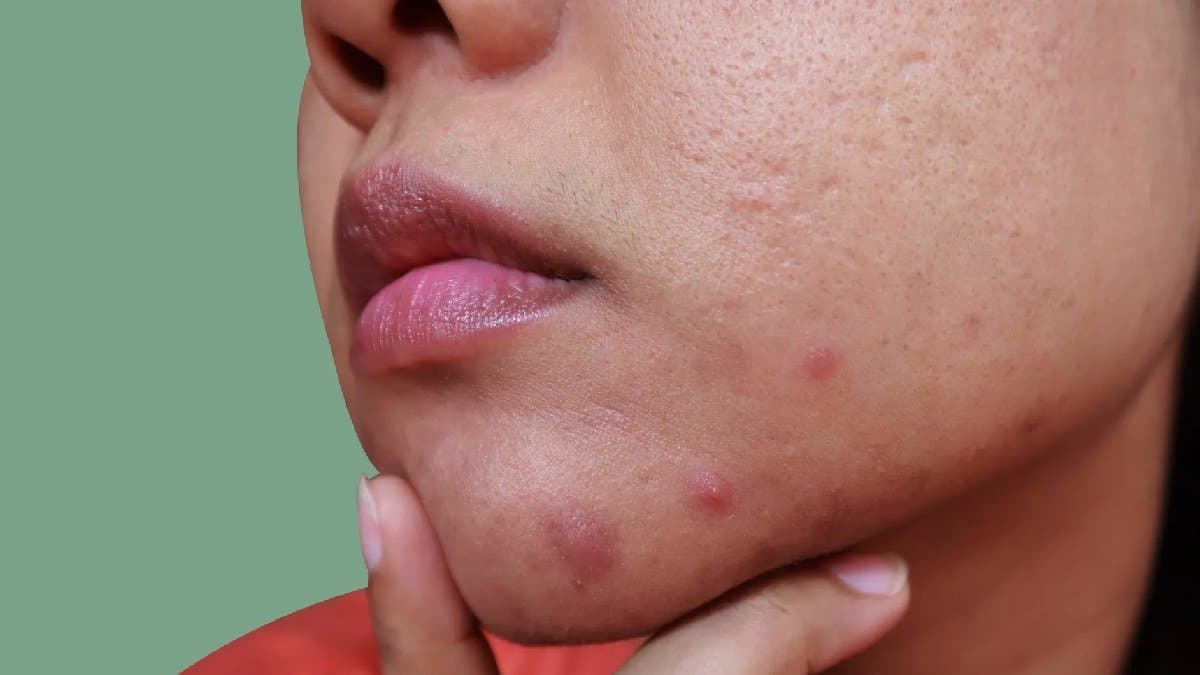 Multani Mitti Rose water Neem Tulsi pack can help reduce acne and pimple