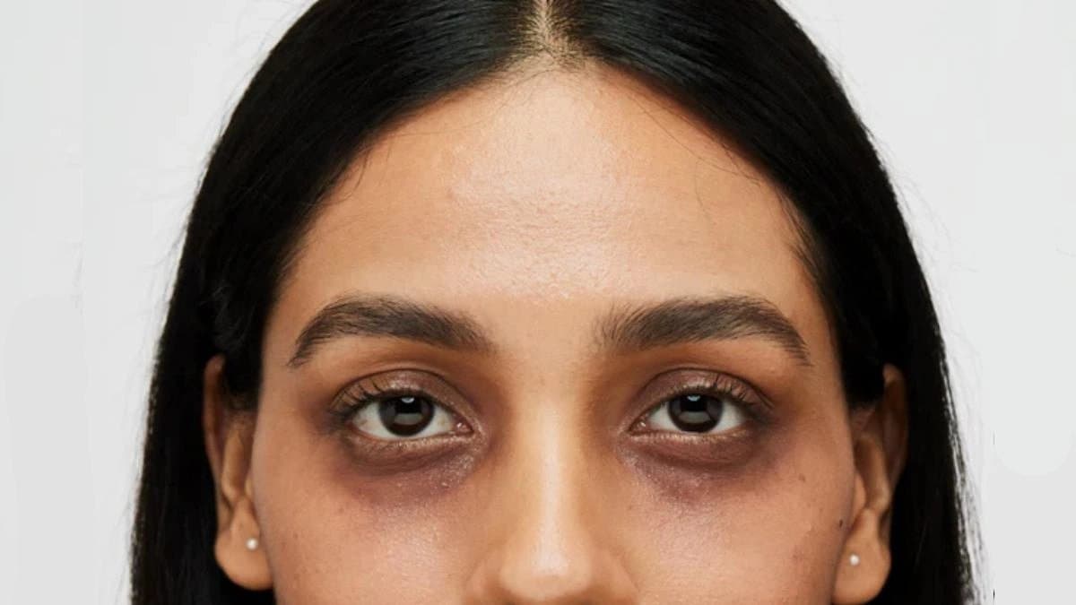 Dark circles Under eye black patch can signal multiple Health Issues