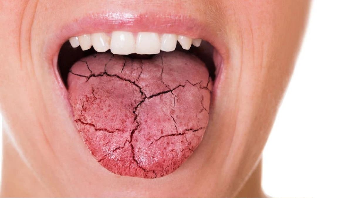 Dry mouth cause and symptoms include Diabetes and Dehydration