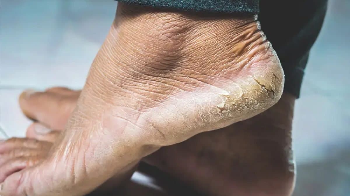 how to get rid of cracked heels lif