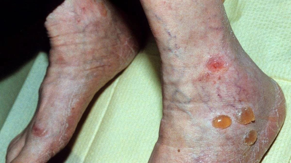 Diabetes Symptoms:  these skin problems cause by diabetes should not ignored