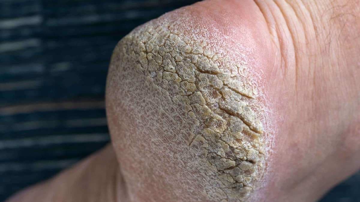 Three Home Remedy of cracked heels