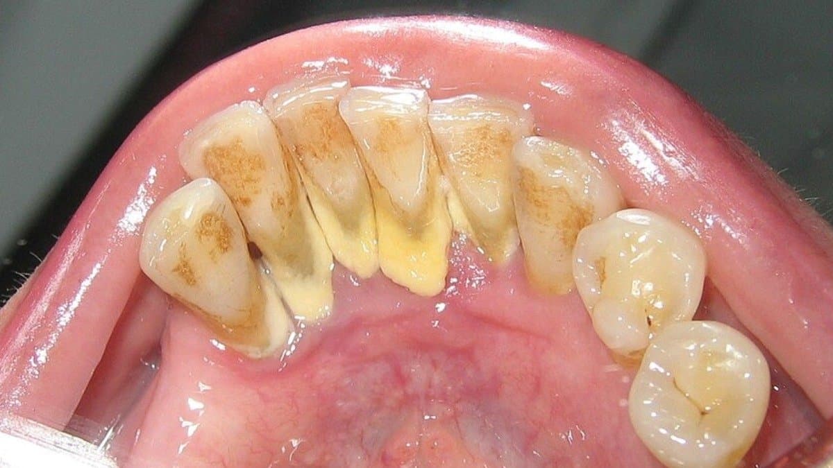 By drinking pineapple juice can reduce dental plaque know how this fruit help to keep teeth healthy