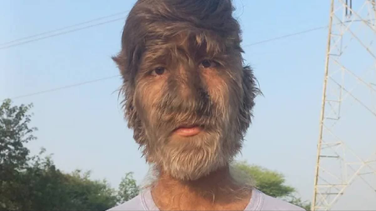 Indian Boy Lalit Patidar With Werewolf Syndrome Gets Guinness Title For Hairiest Face 