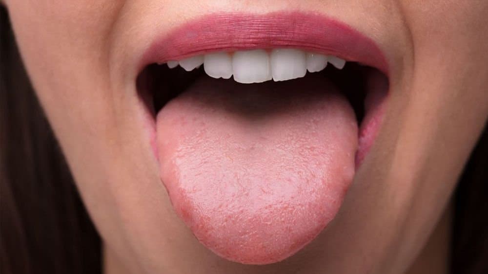colour change of tongue may be symptoms of various diseases here is the details LIF