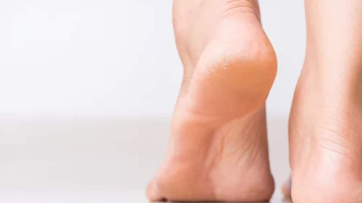 this home made remedy can prevent cracked heels and 