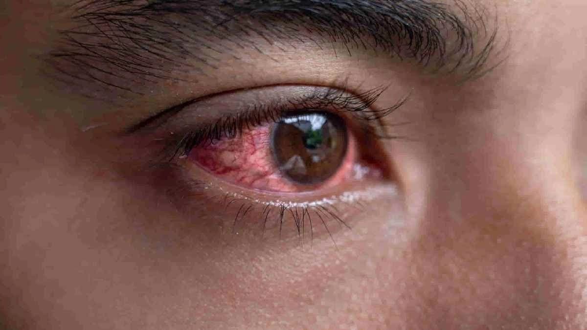 Delhi-NCR Sees Unusual Surge In Eye Flu Cases This Monsoon 