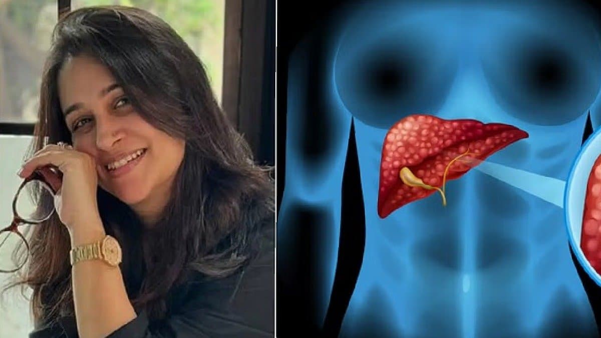 Famous actress Dipika Kakar diagnosed with liver cancer these symptoms of deadly disease must not ignore 
