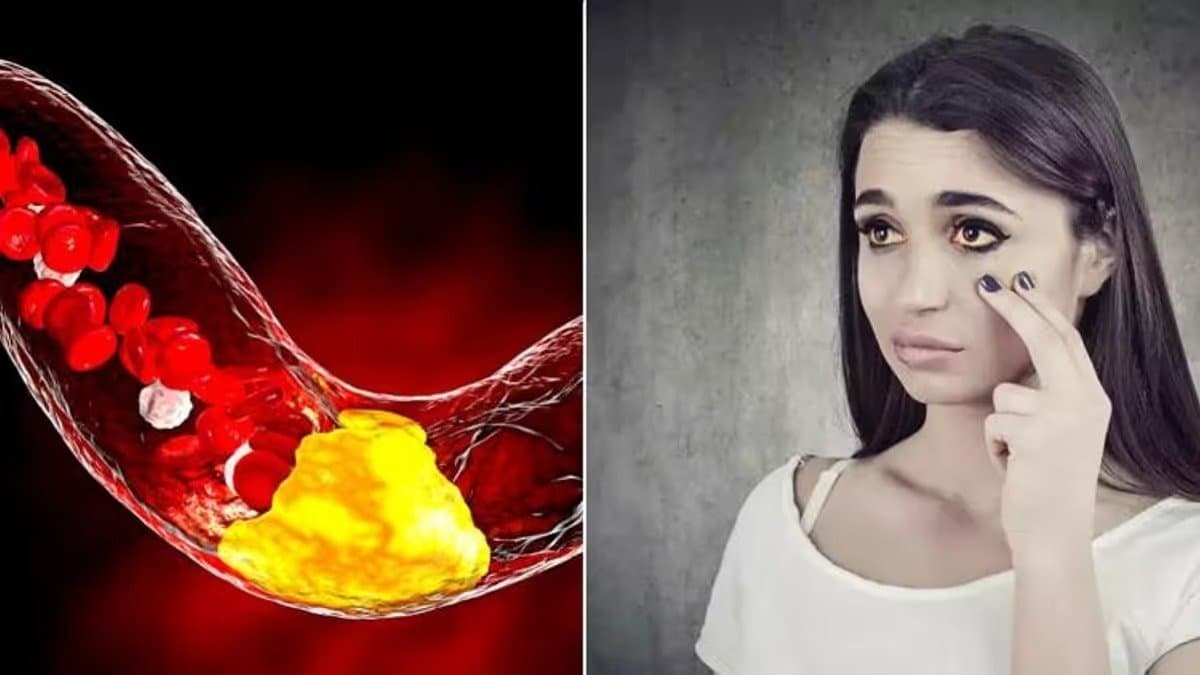 These High cholesterol symptoms seen in females should not be ignored