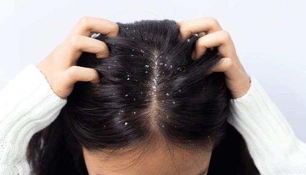 How to prevent dandruff problem in Summer  
