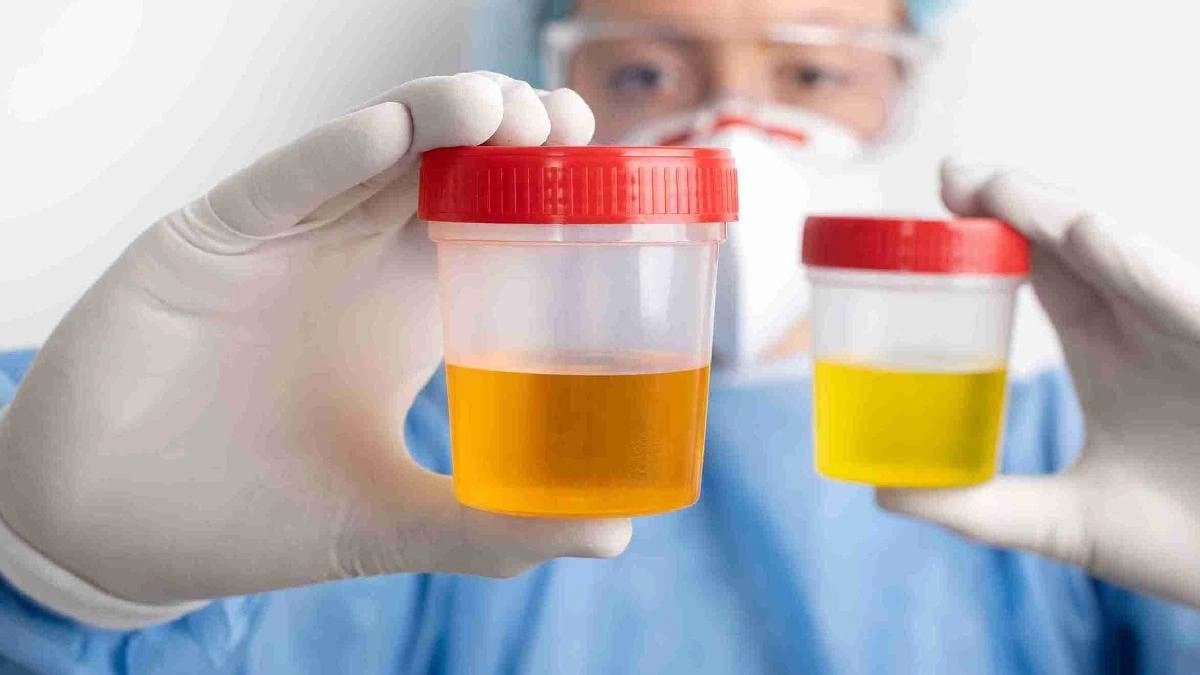 What does your Urine tells about your health