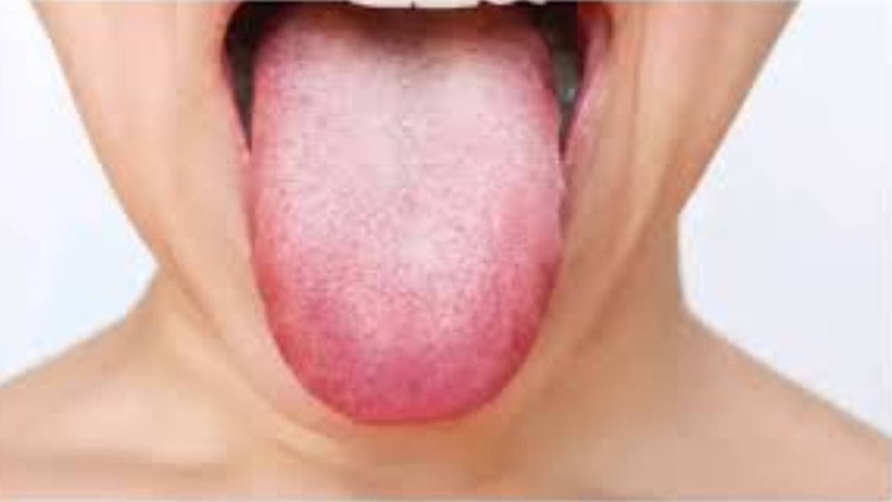 Tongue colour indicates your severe disease