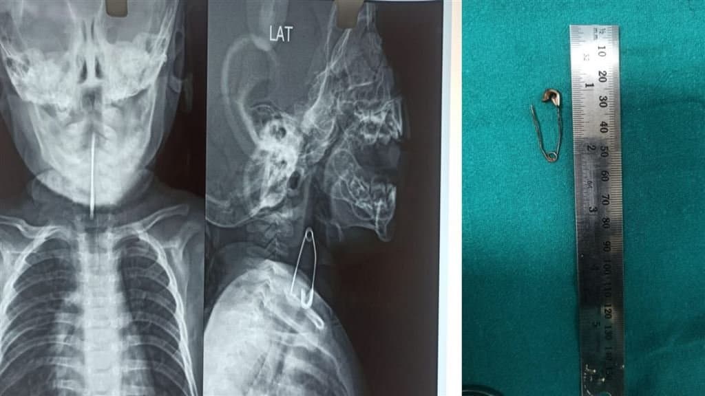 Calcutta Medical College: পাঁচ মাসের শিশুর শ্বাসনালীর কাছে আটকে ছিল মুখ খোলা সেফটিপিন, নিয়ে আসা হল কলকাতা মেডিক্যাল কলেজে, তারপর? 