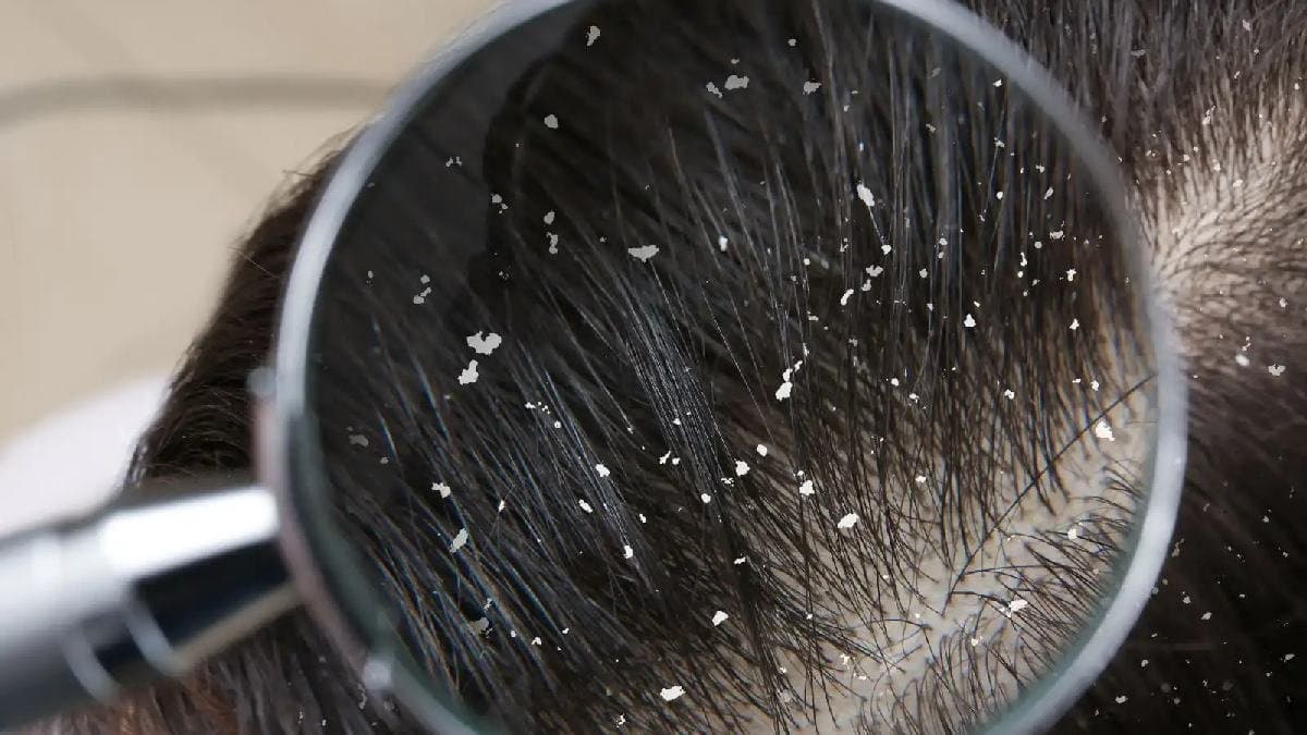 Three home remedies to clean hair dandruff in summer
