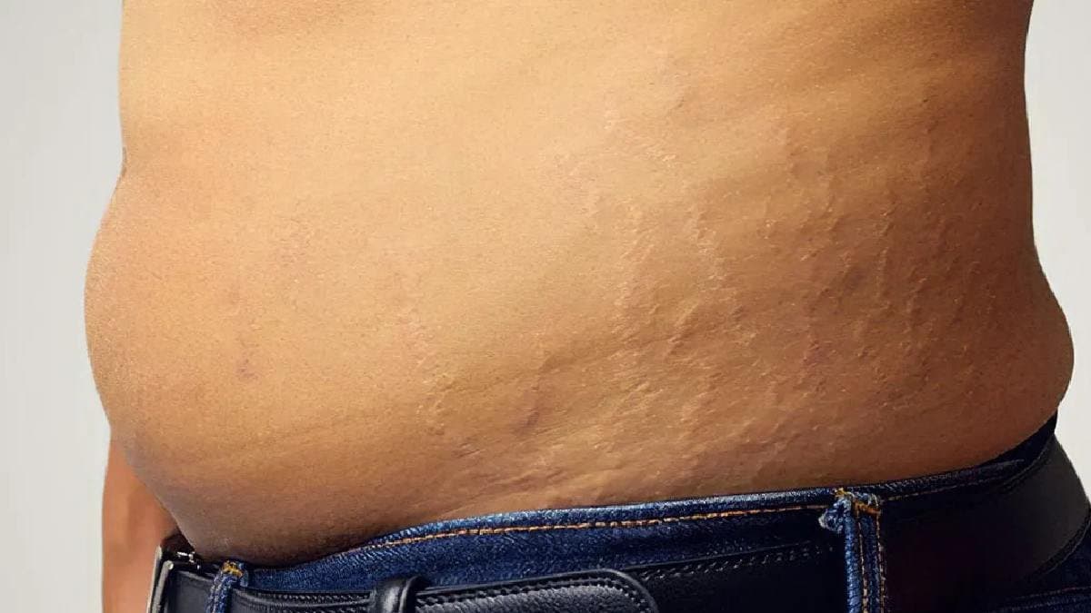 Use these home remedies to get rid of Strech Marks